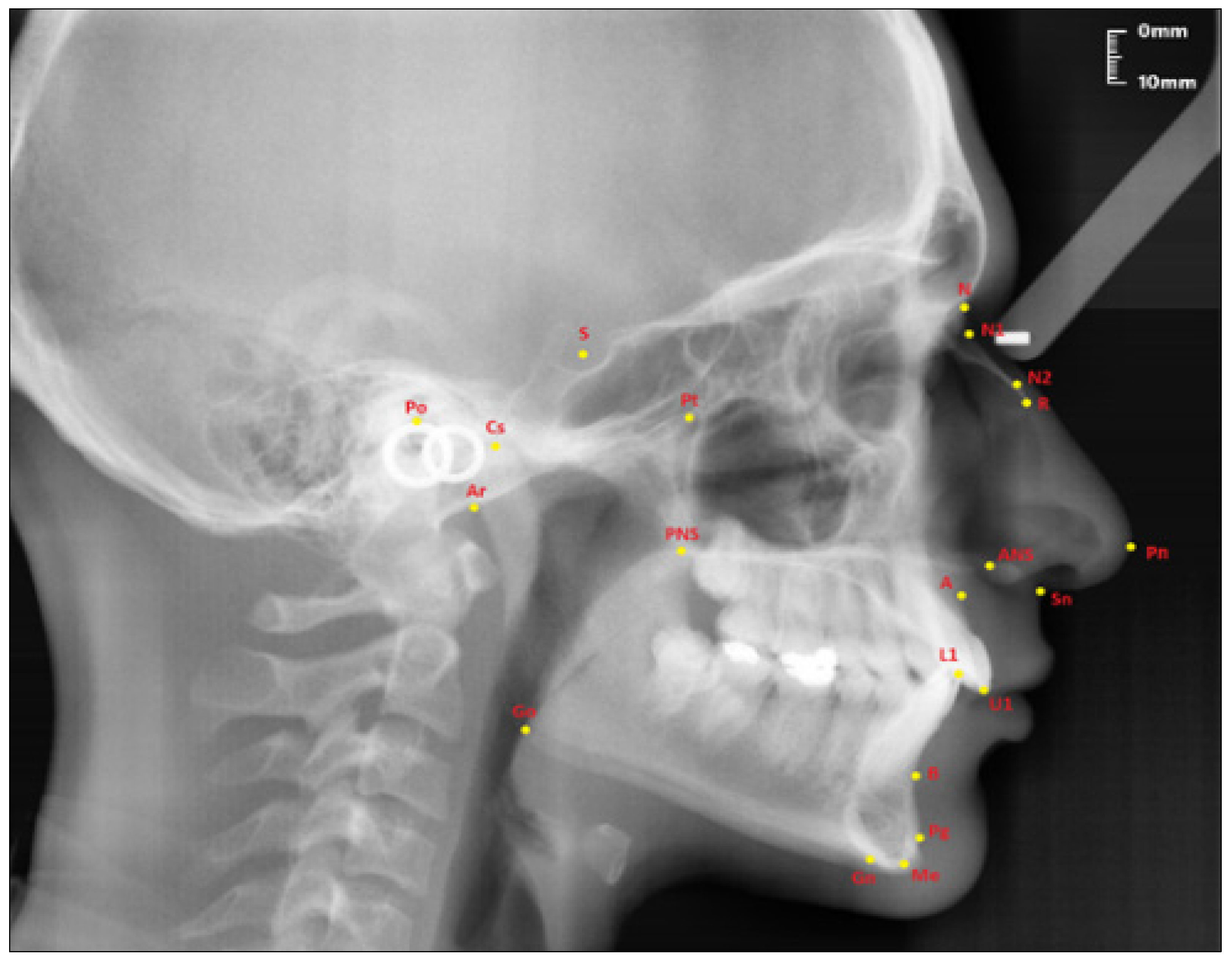Nasal Bone Anatomy Xray