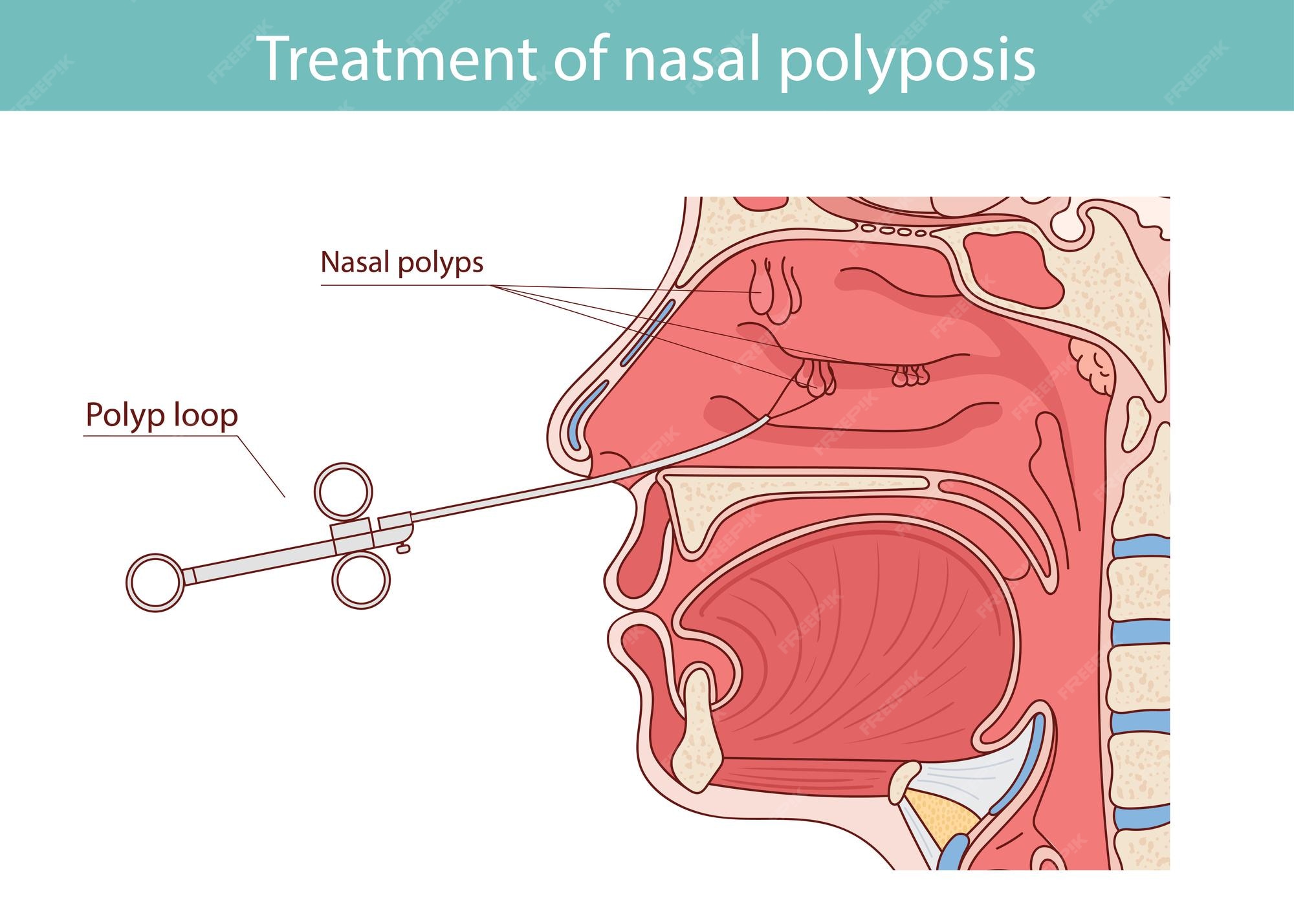 Nasal Polyps Images