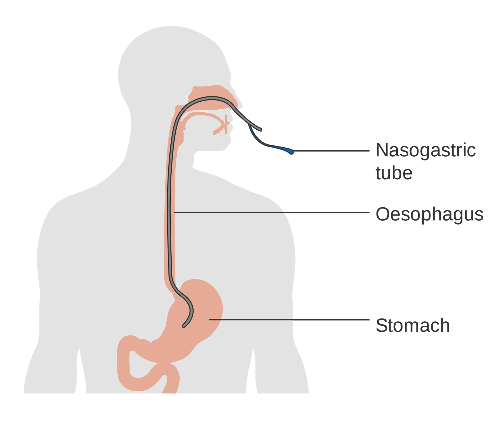 Nasogastric Tube Placement