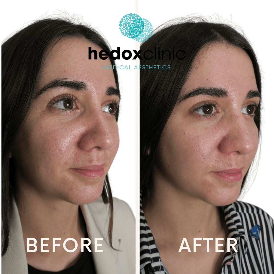 Nasolabial Folds Treatment