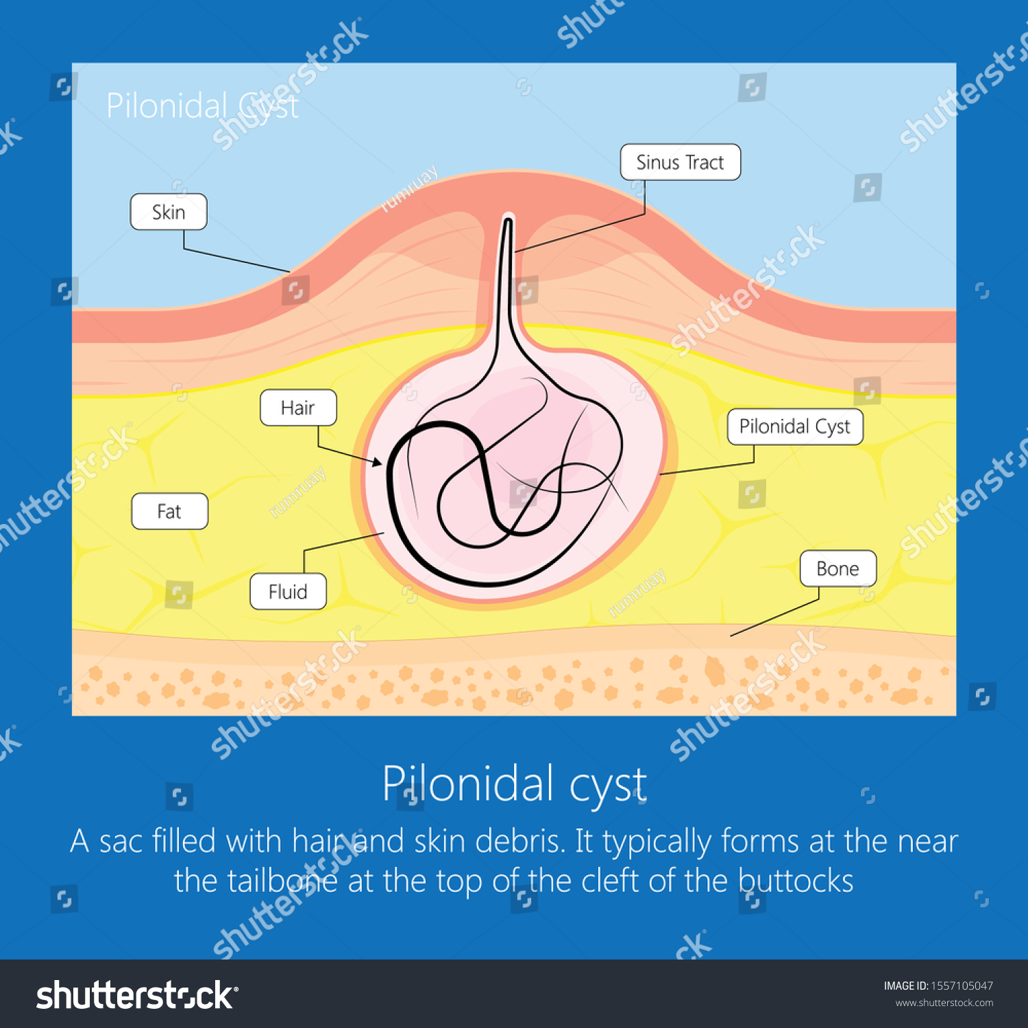 Nest Of Hair Cyst