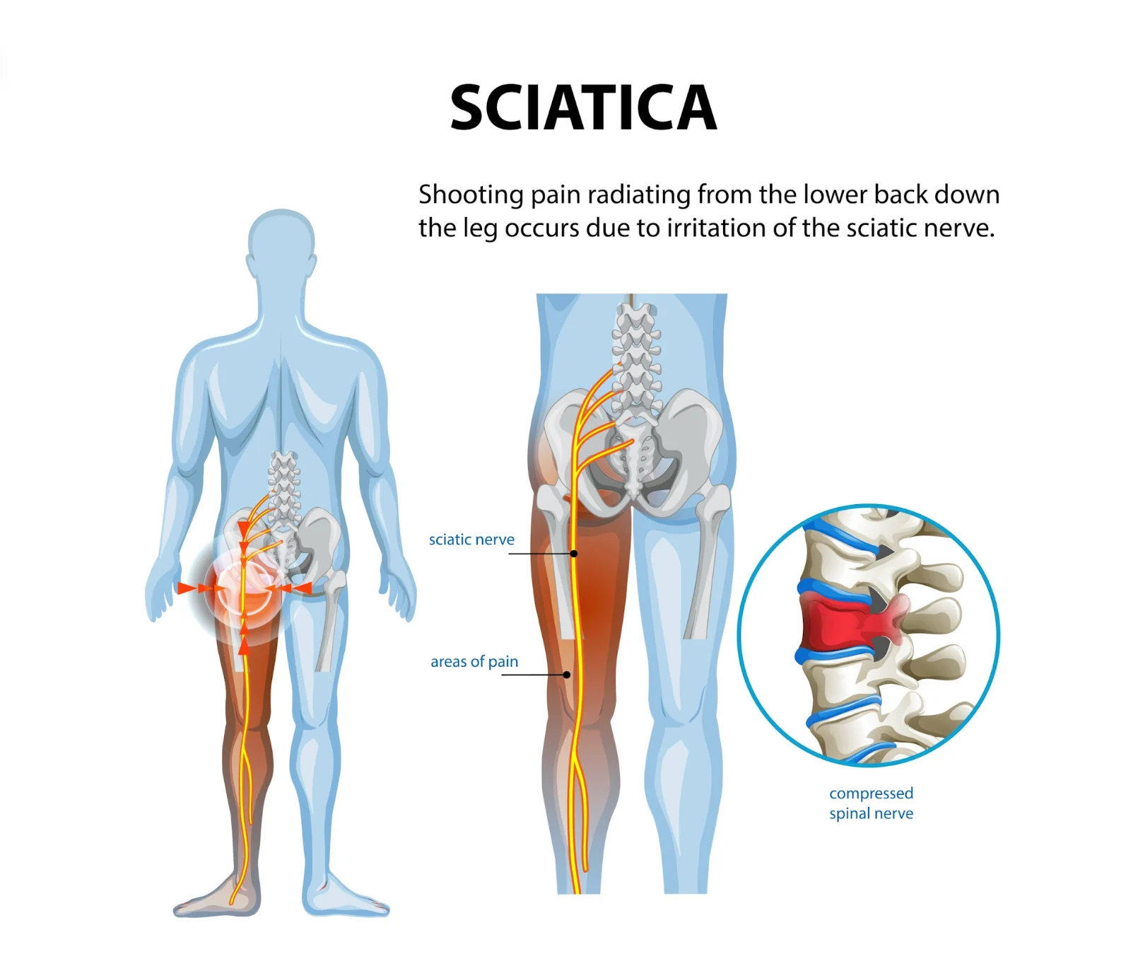 Neuropathic Pain In Thigh