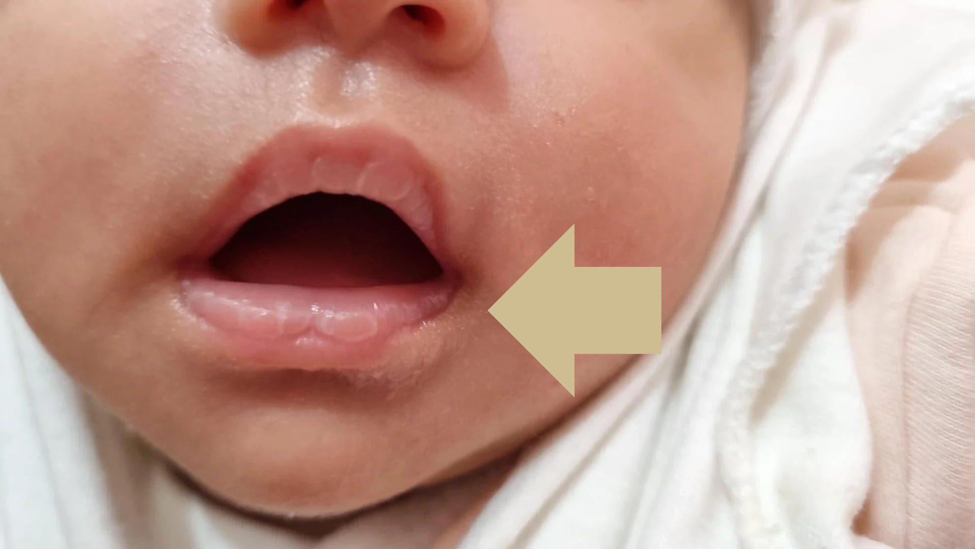 Newborn Nursing Blisters Lips