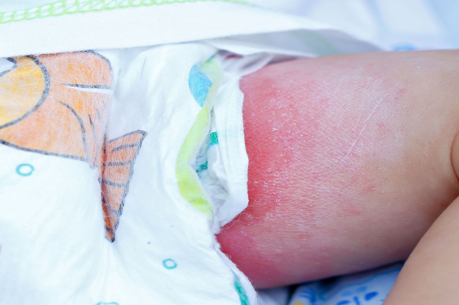 Newborns And Diaper Rash