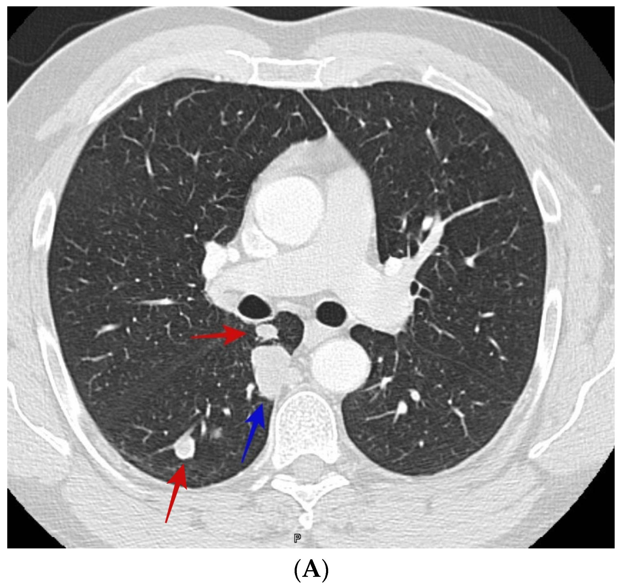 Node In Lung Ct Scan