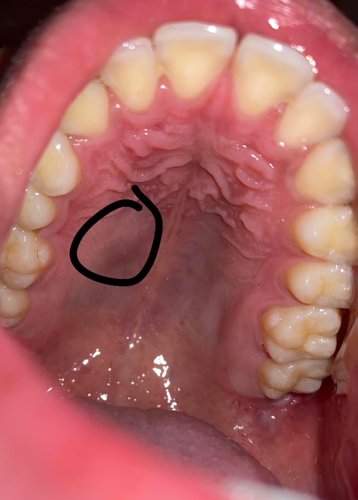 Nodule In Roof Of Mouth