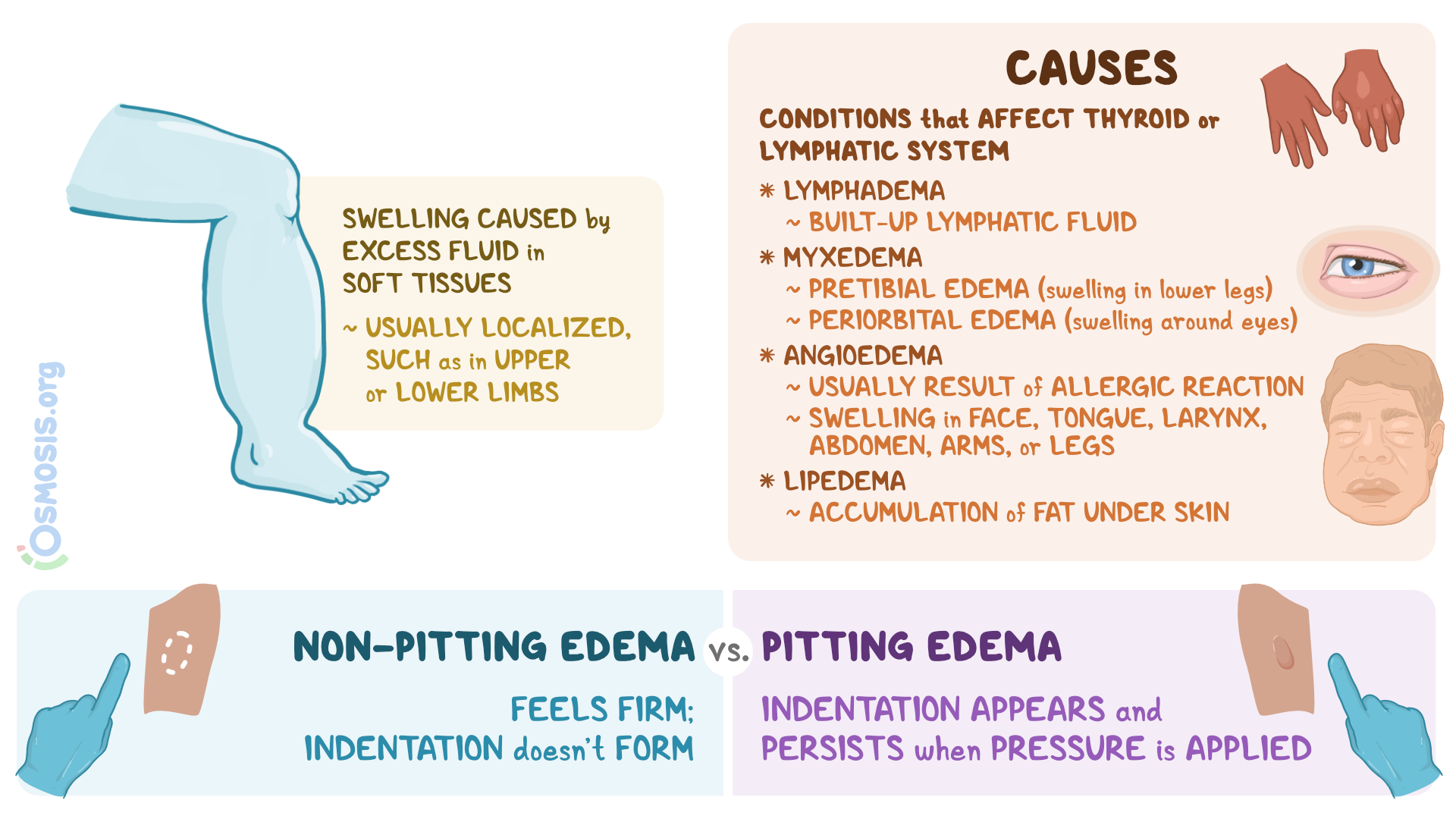 Non Pitting Edema Disease