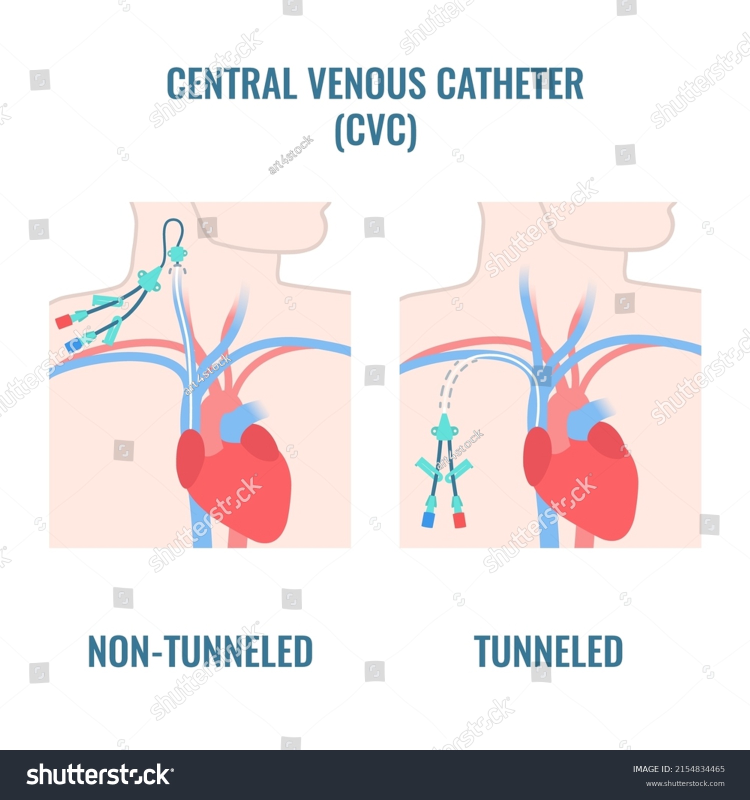 Nontunneled Cvc Catheter