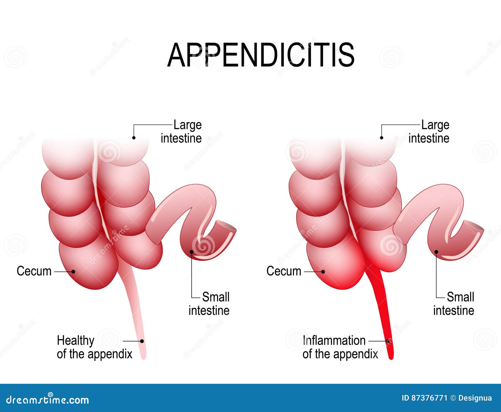 Normal Appendix Size