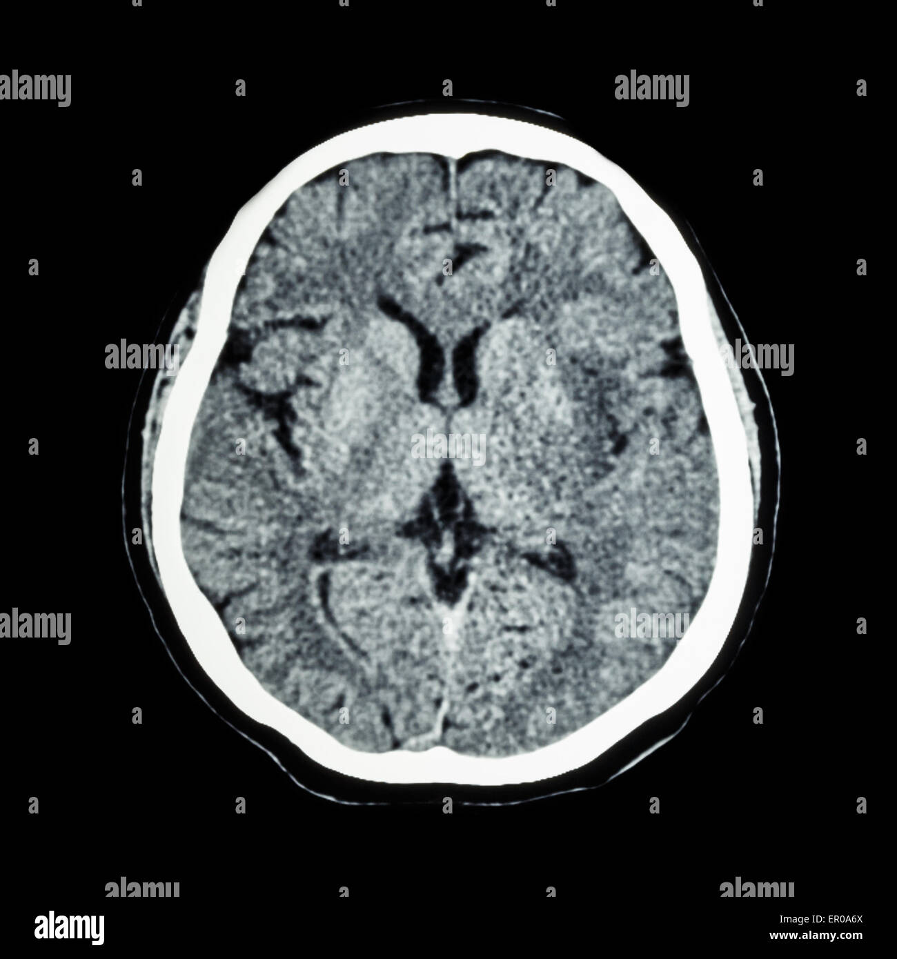 Normal Brain Ct