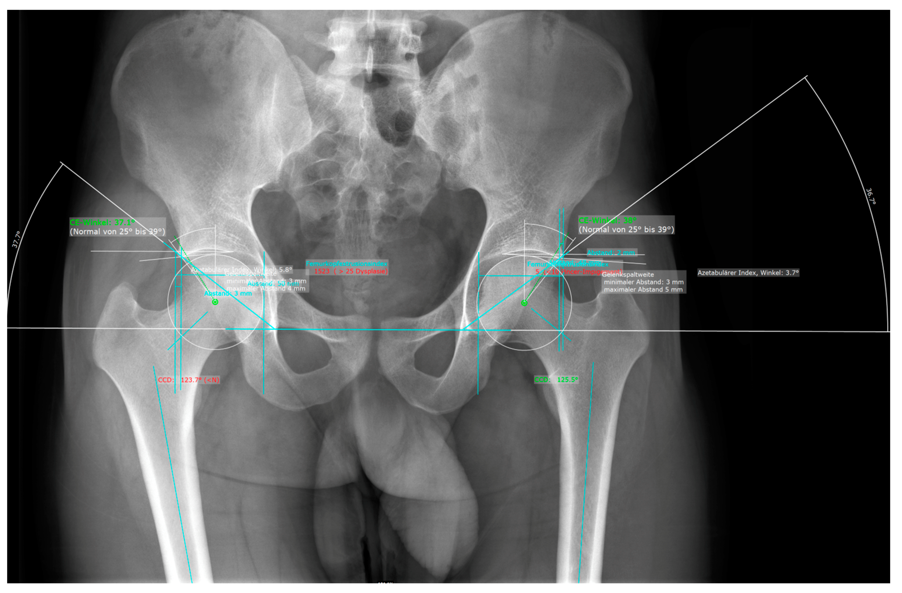 Normal Hip Xray