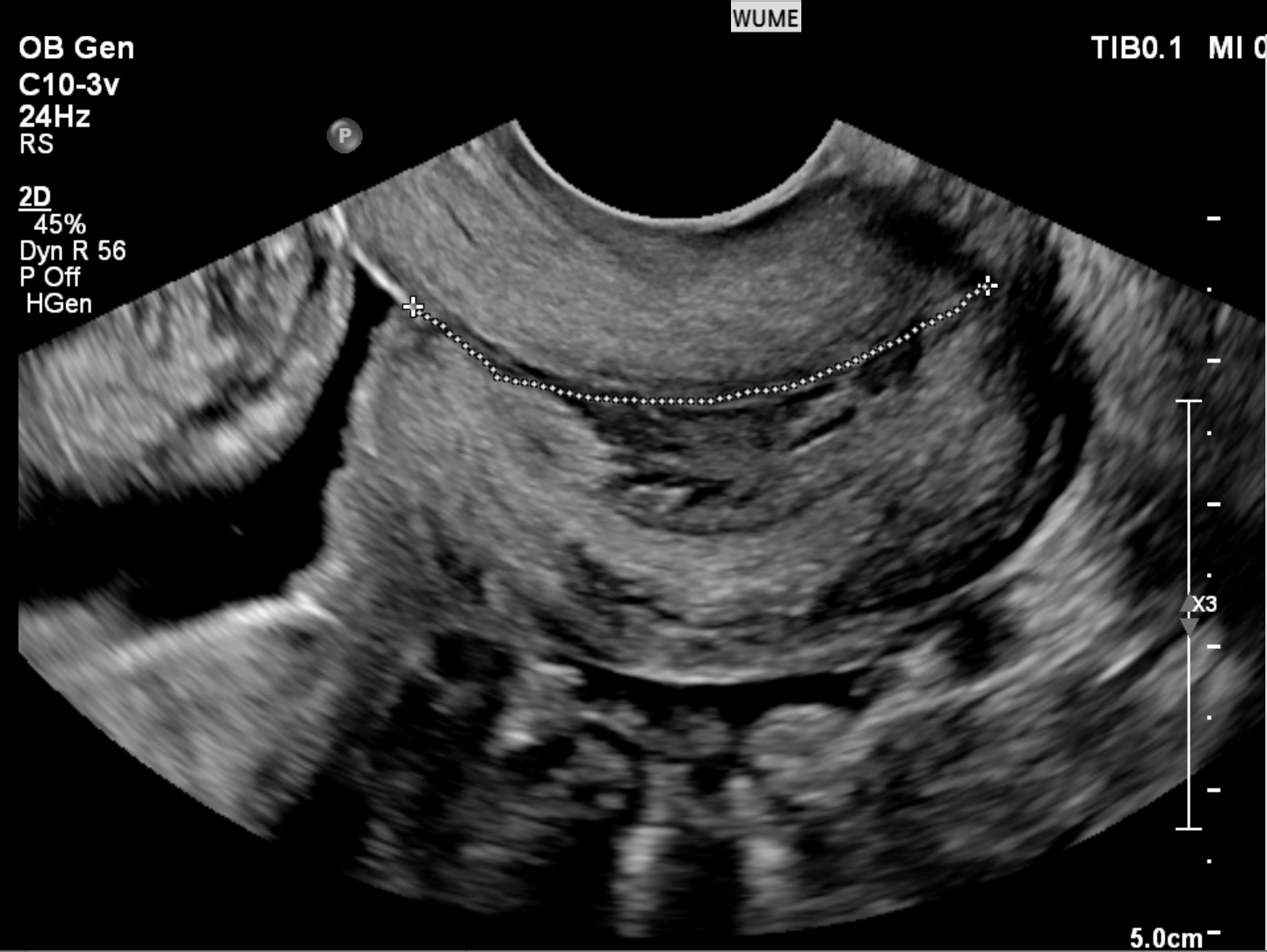 Normal Length Cervix