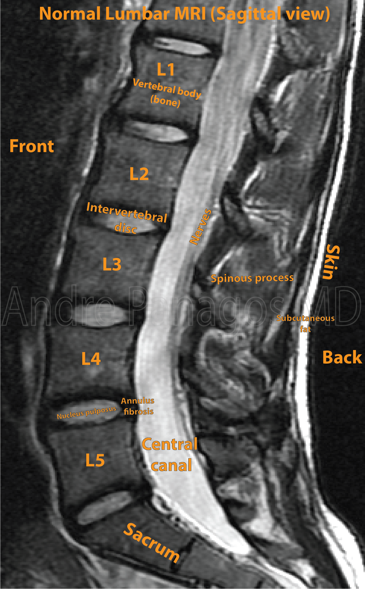 Normal Lumbar Mri