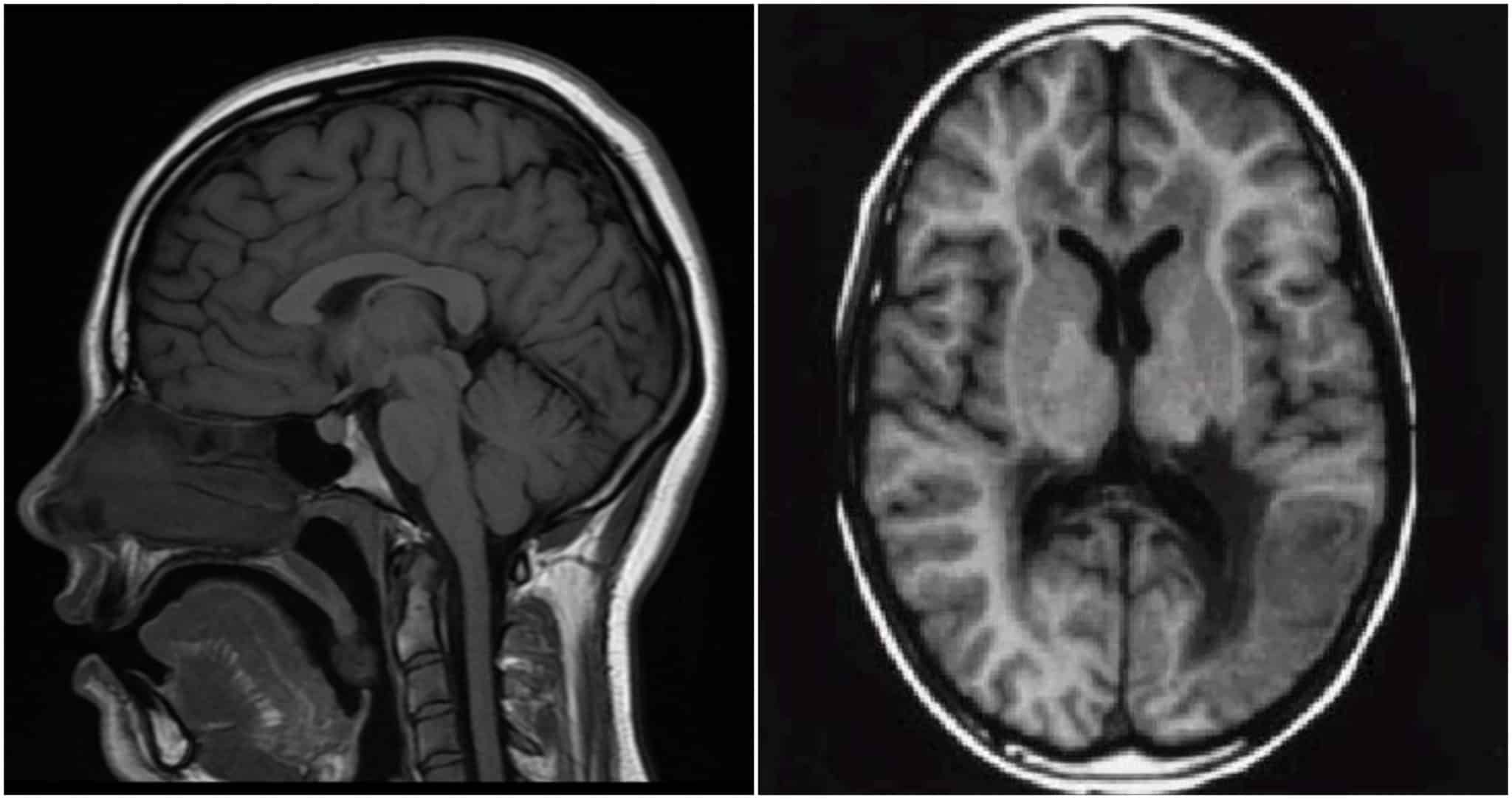 Normal Mri Brain