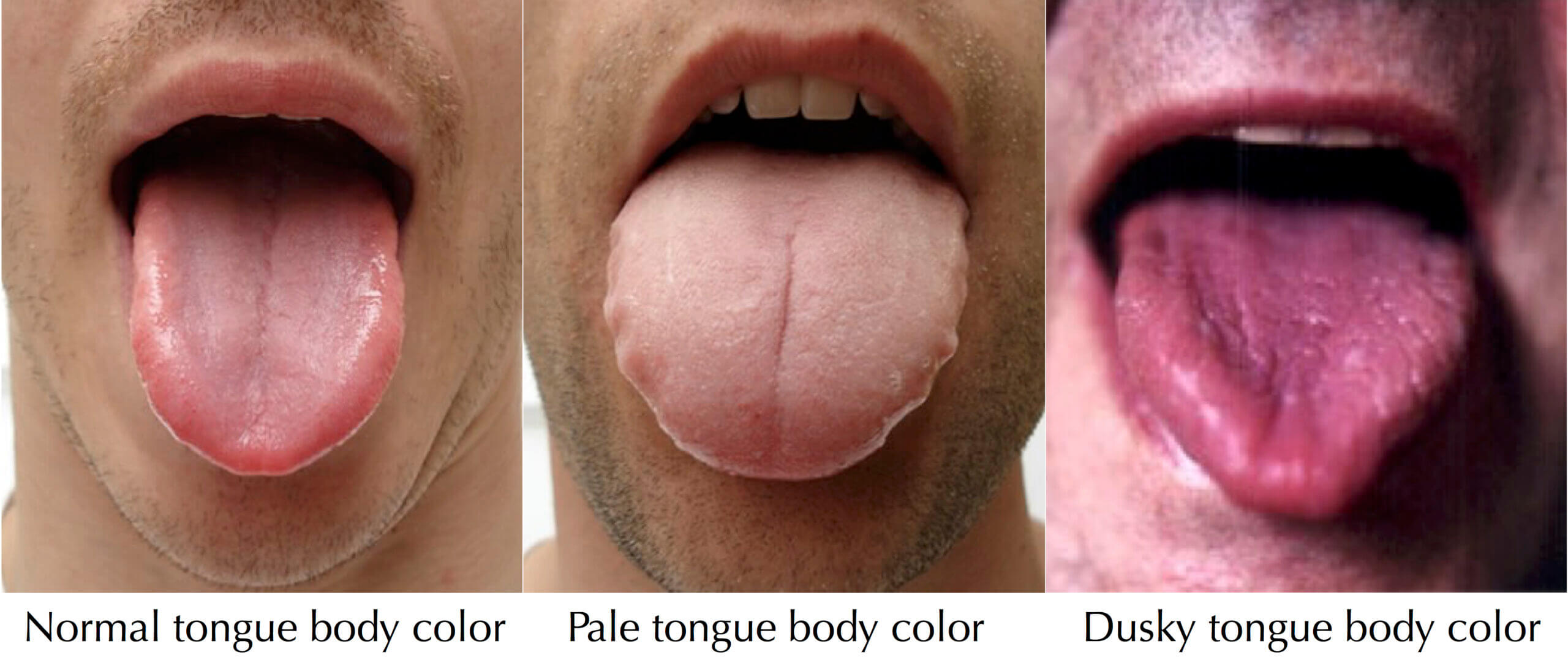 Normal Tongue Color