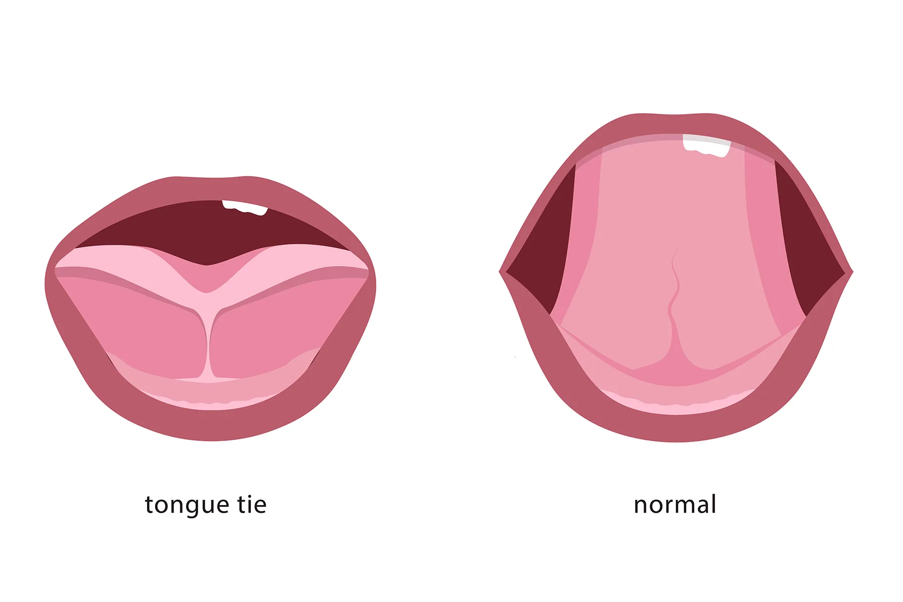 Normal Tongue Tied