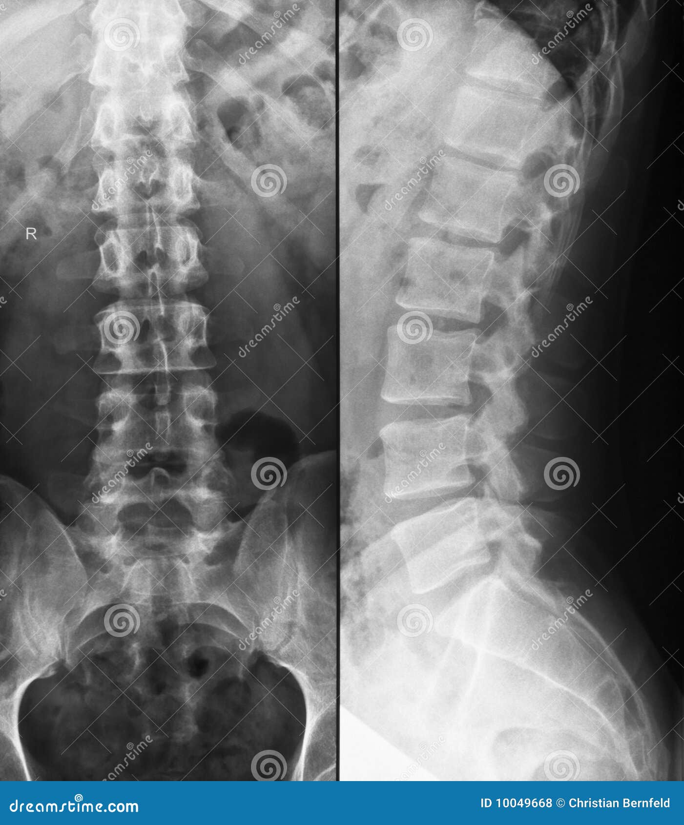Normal X Ray Ls Spine