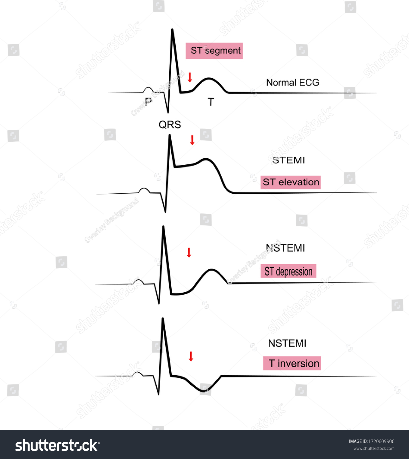 Nstemi Ekg