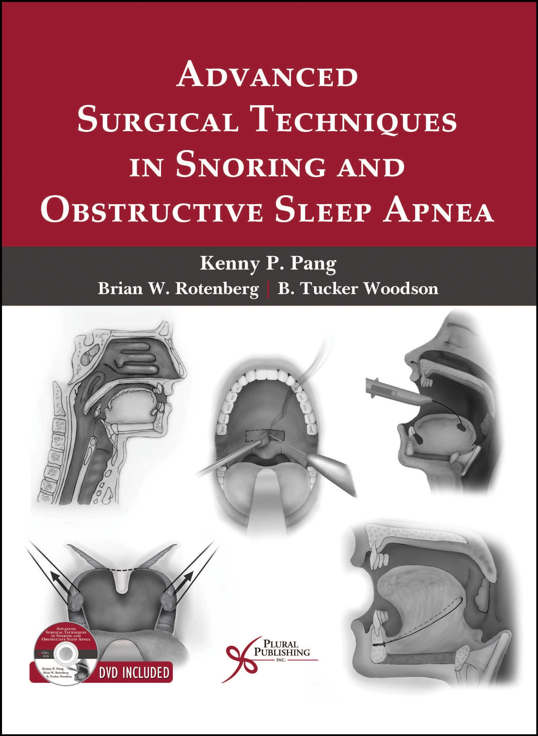 Obstructive Sleep Apnea Surgery