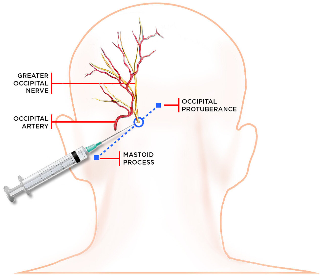 Occipital Nerve Block