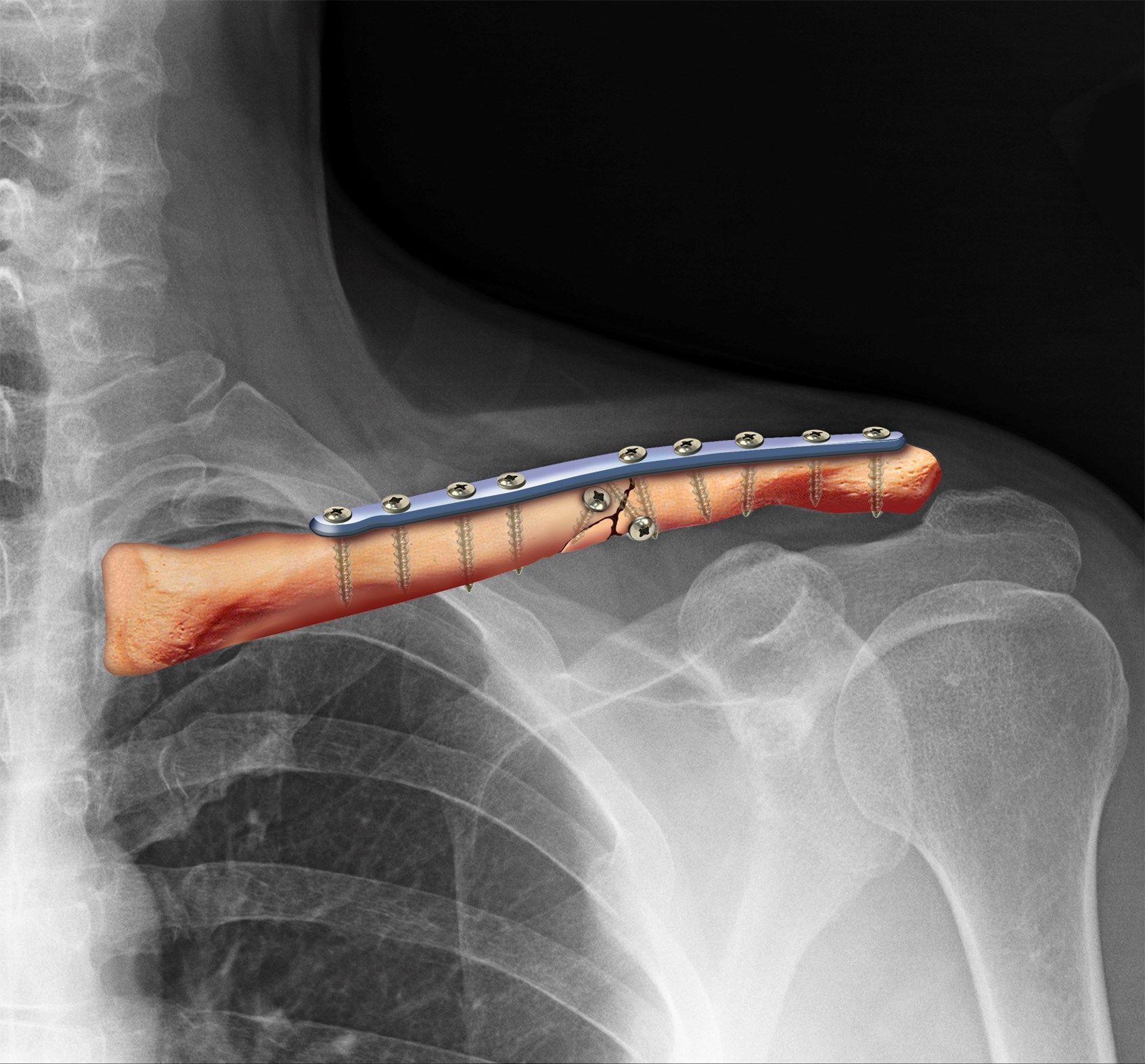 Open Fixation Surgery