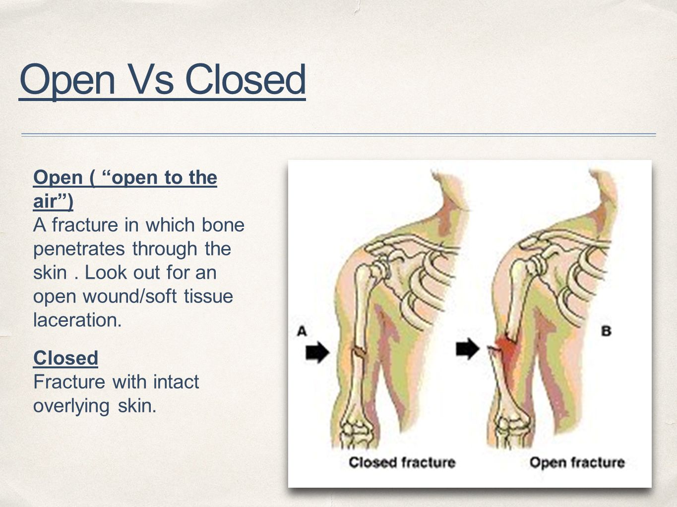 Open Reduction Vs Closed Reduction