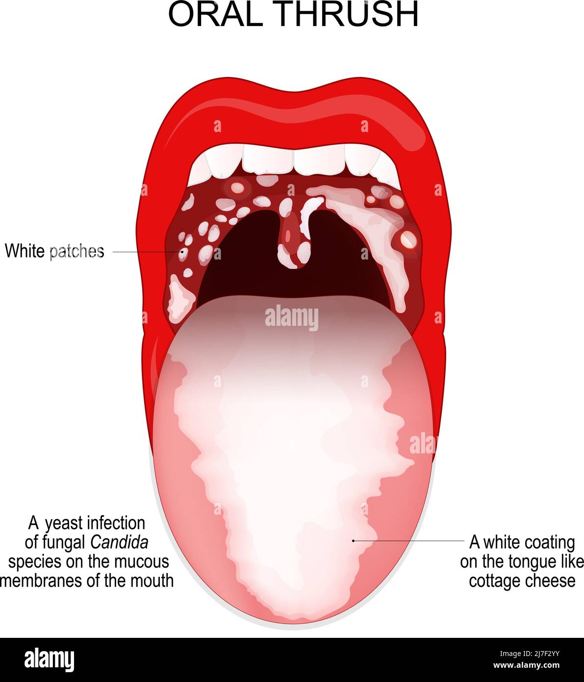 Oral Infection Treatment