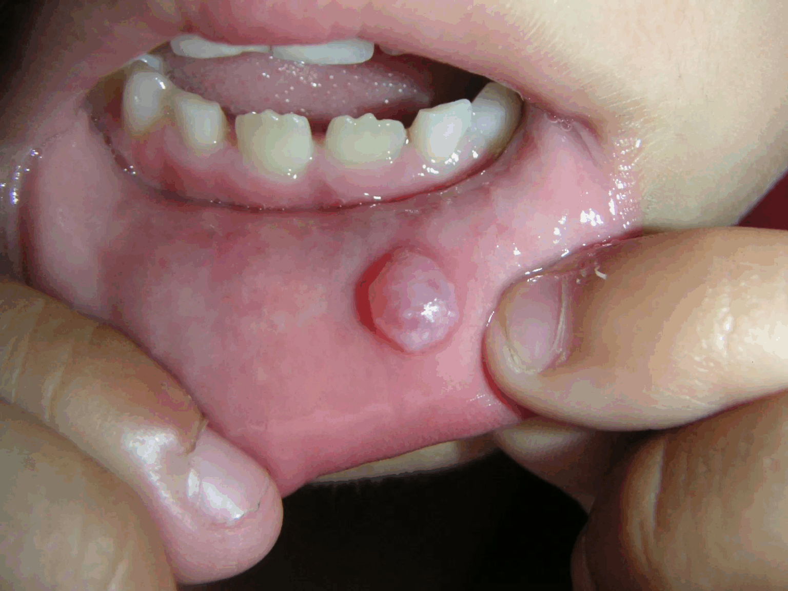 Oral Mucocele Cancer