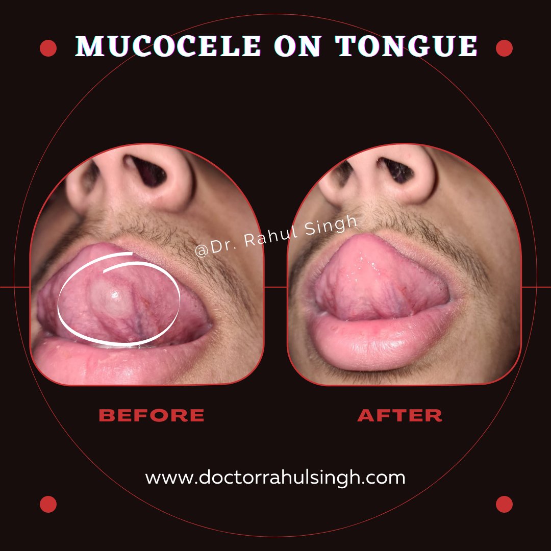 Oral Mucocele Supportive Therapy