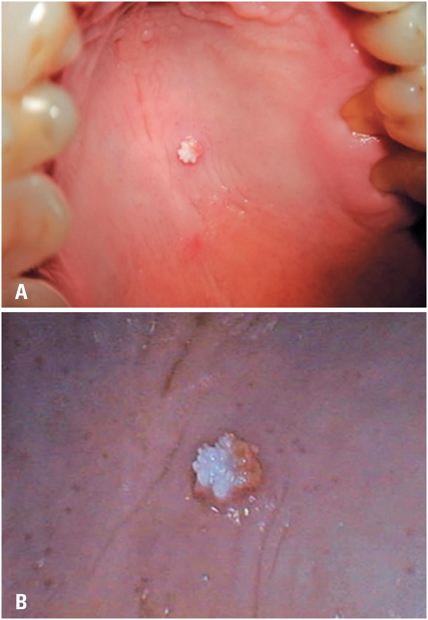 Oral Squamous Papilloma