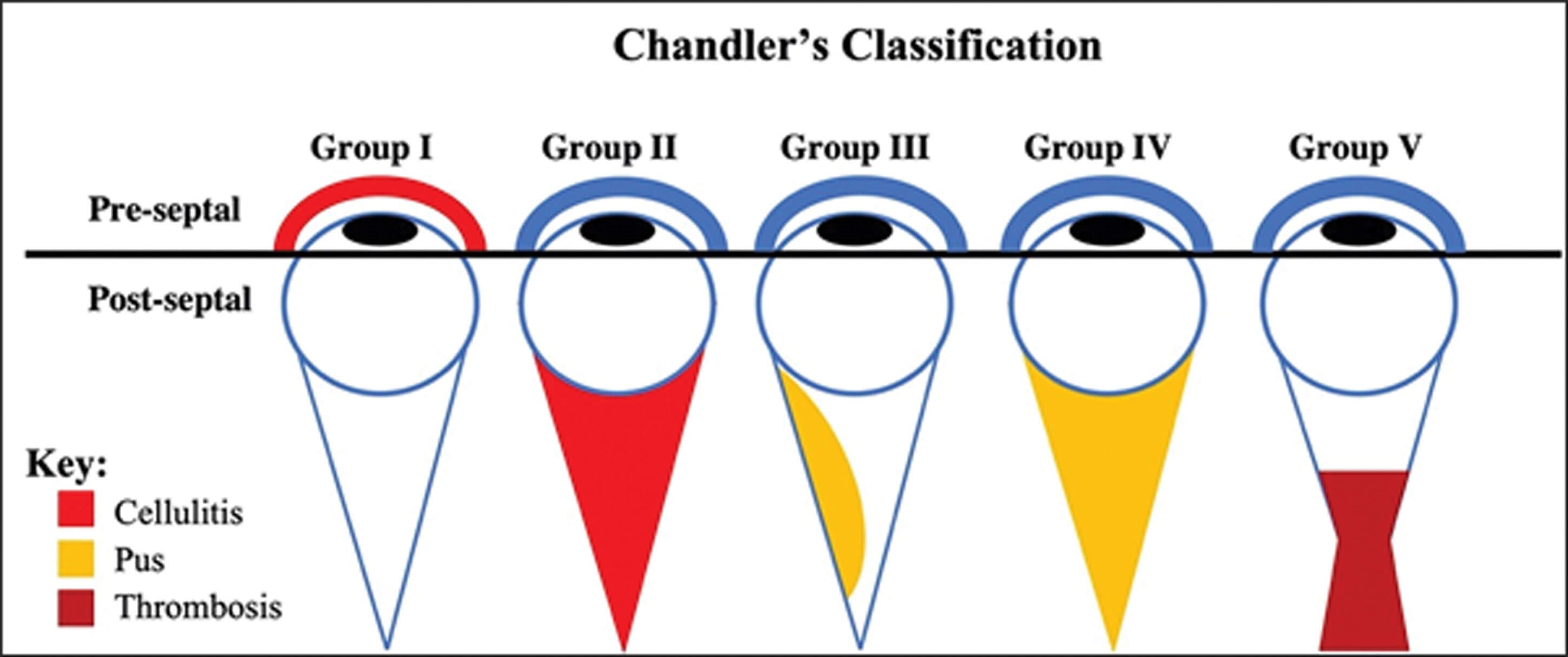 Orbital Cellulitis Stages