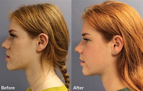 Orthognathic Surgery Before And After