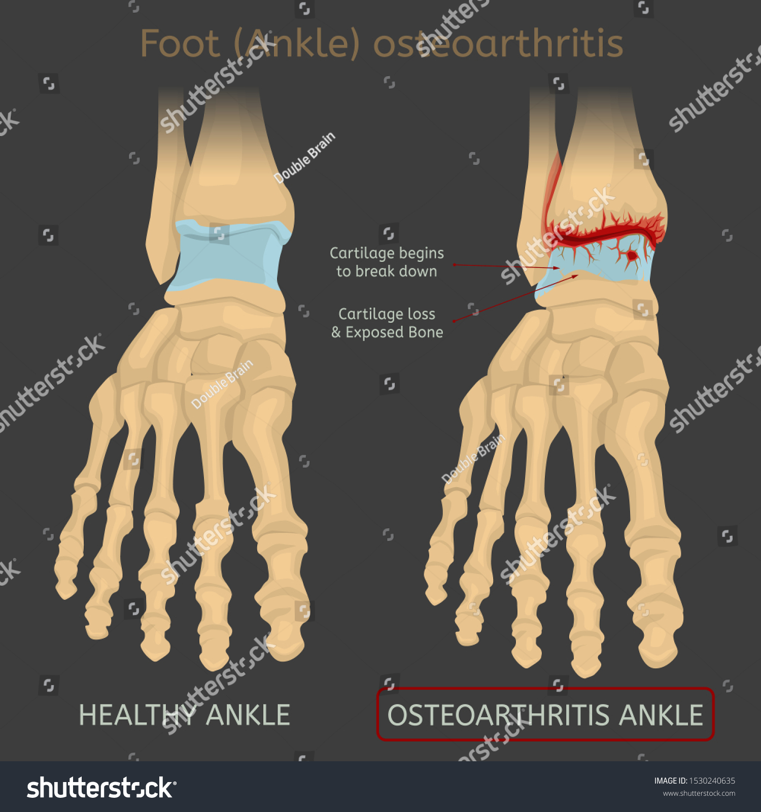 Osteoarthritis In Feet