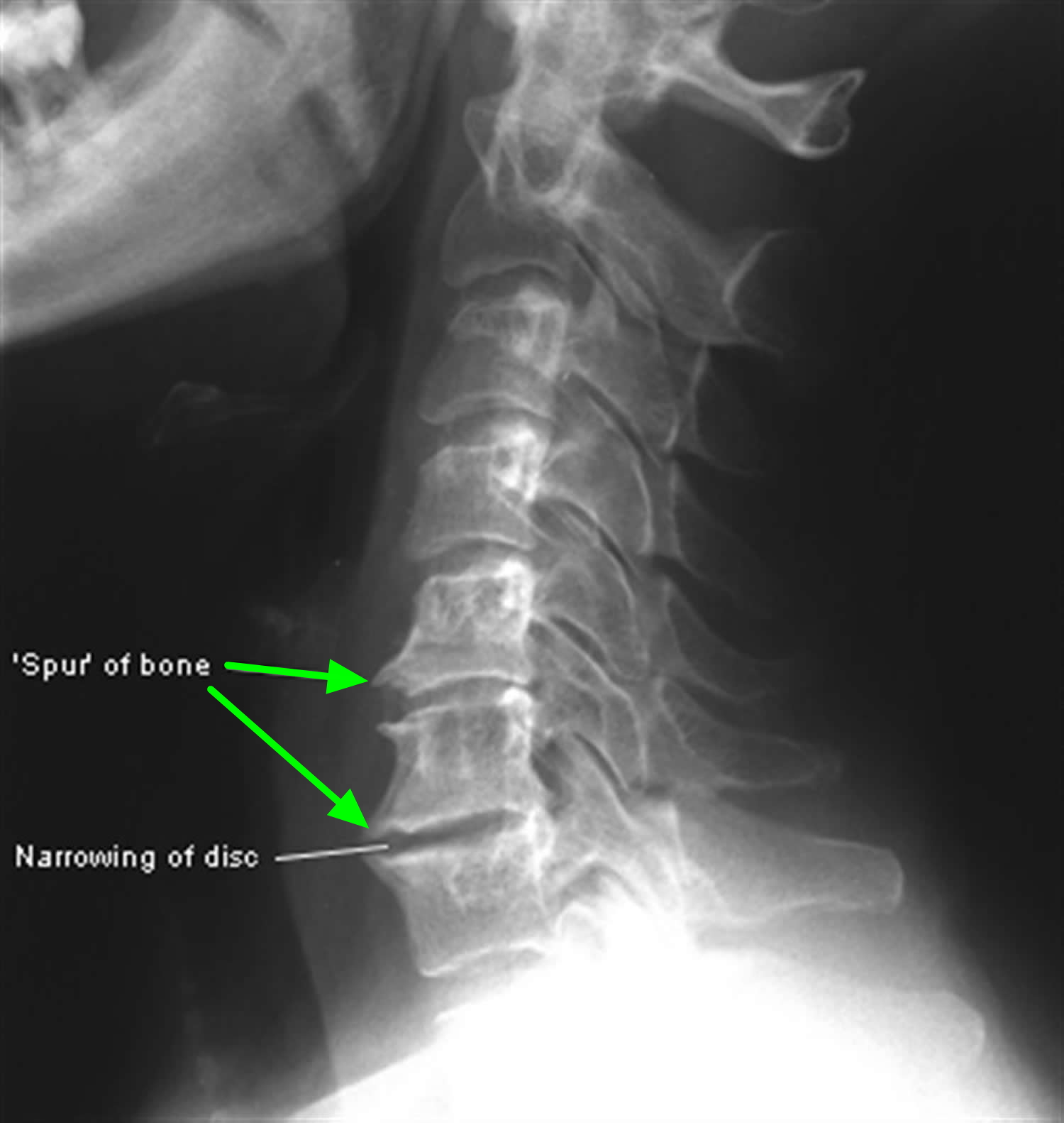 Osteophytes In Cervical Vertebrae