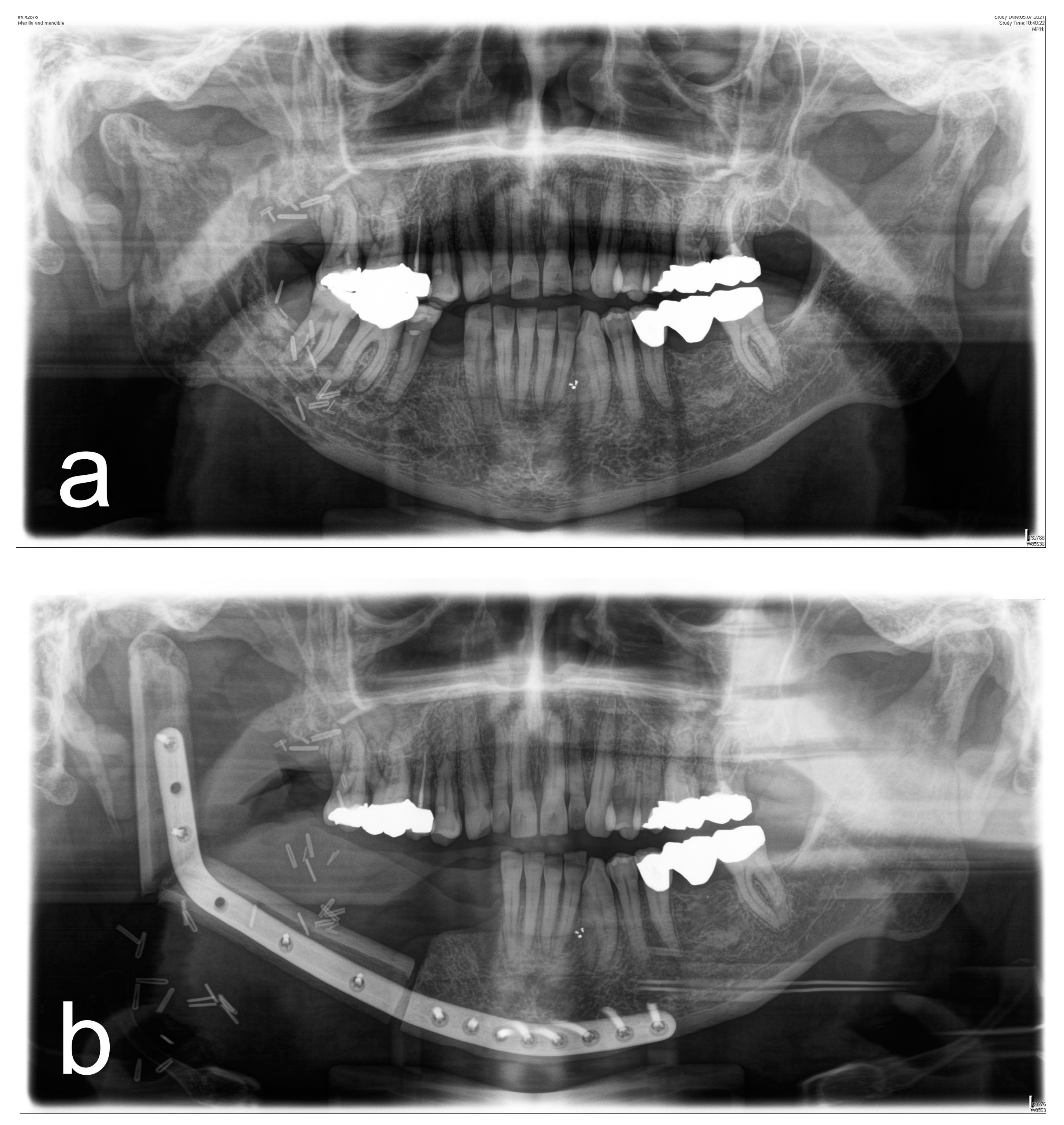 Osteoradionecrosis Of The Jaw