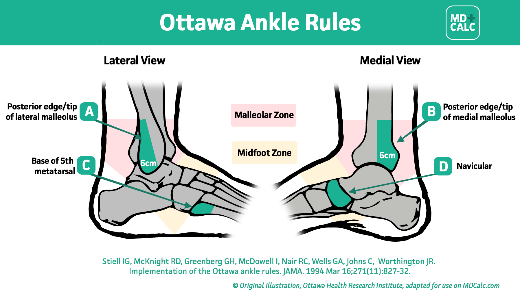 Ottowa Ankle Rules