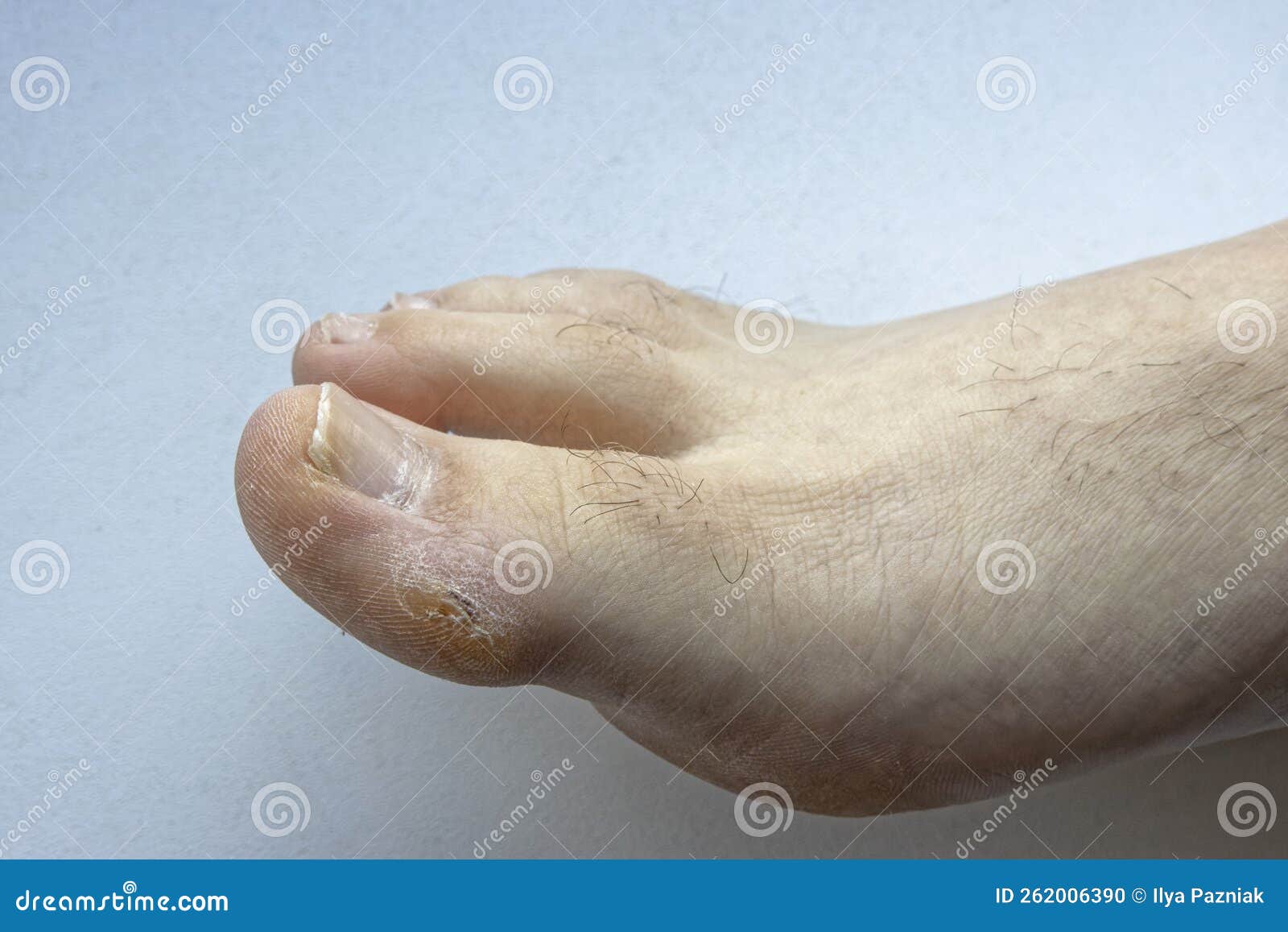 Outside Of Big Toe Callus
