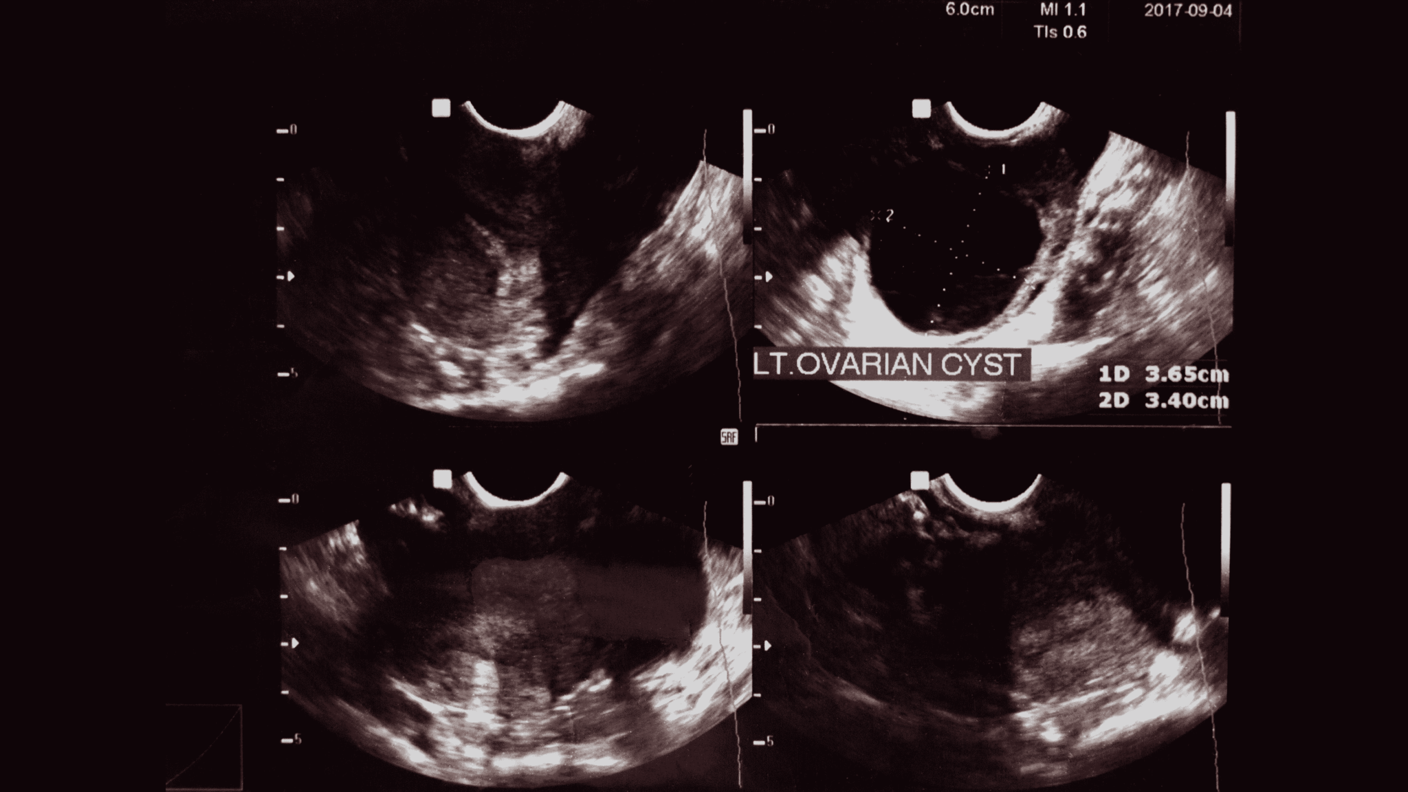 Ovarian Cyst Burst