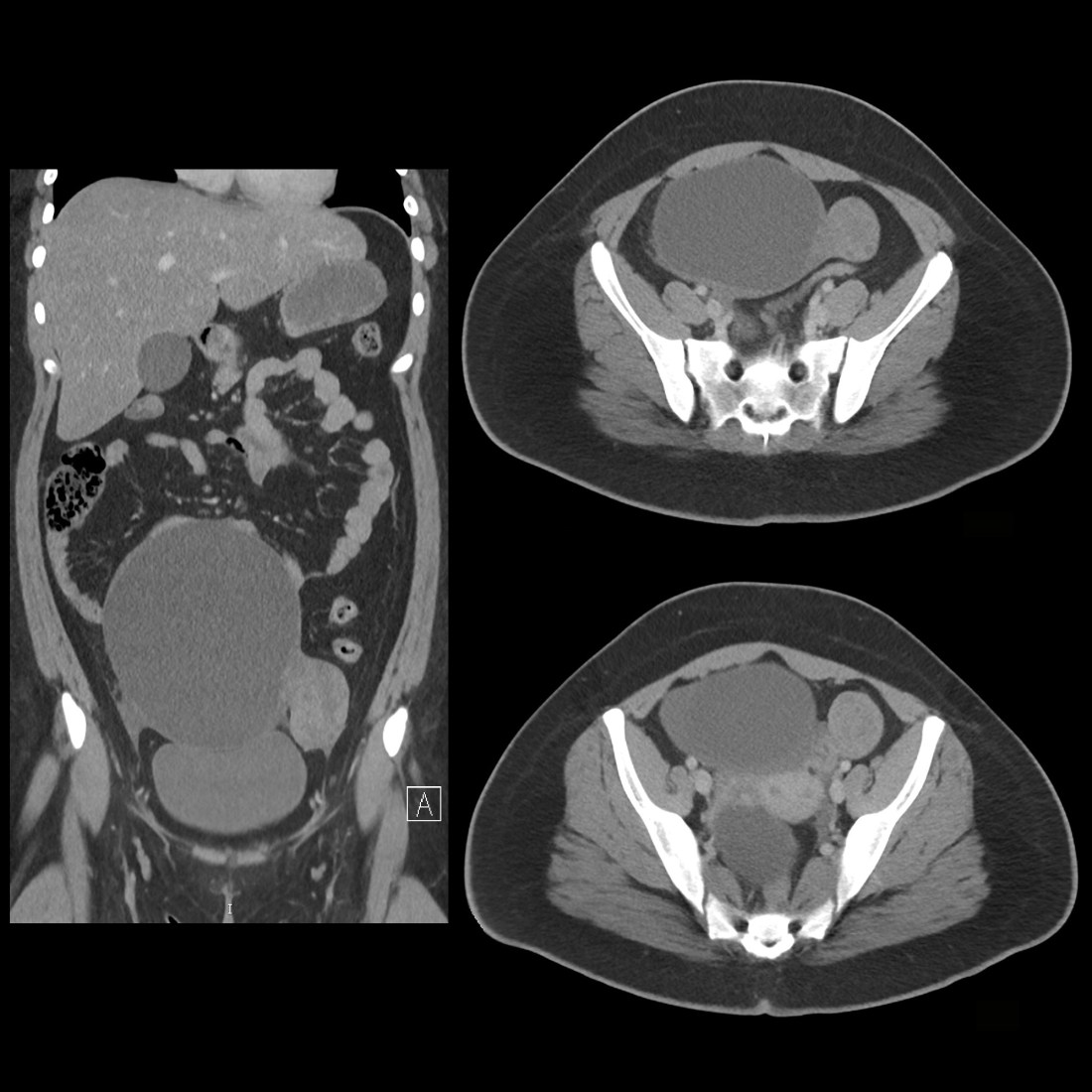 Ovarian Cyst Ct Scan