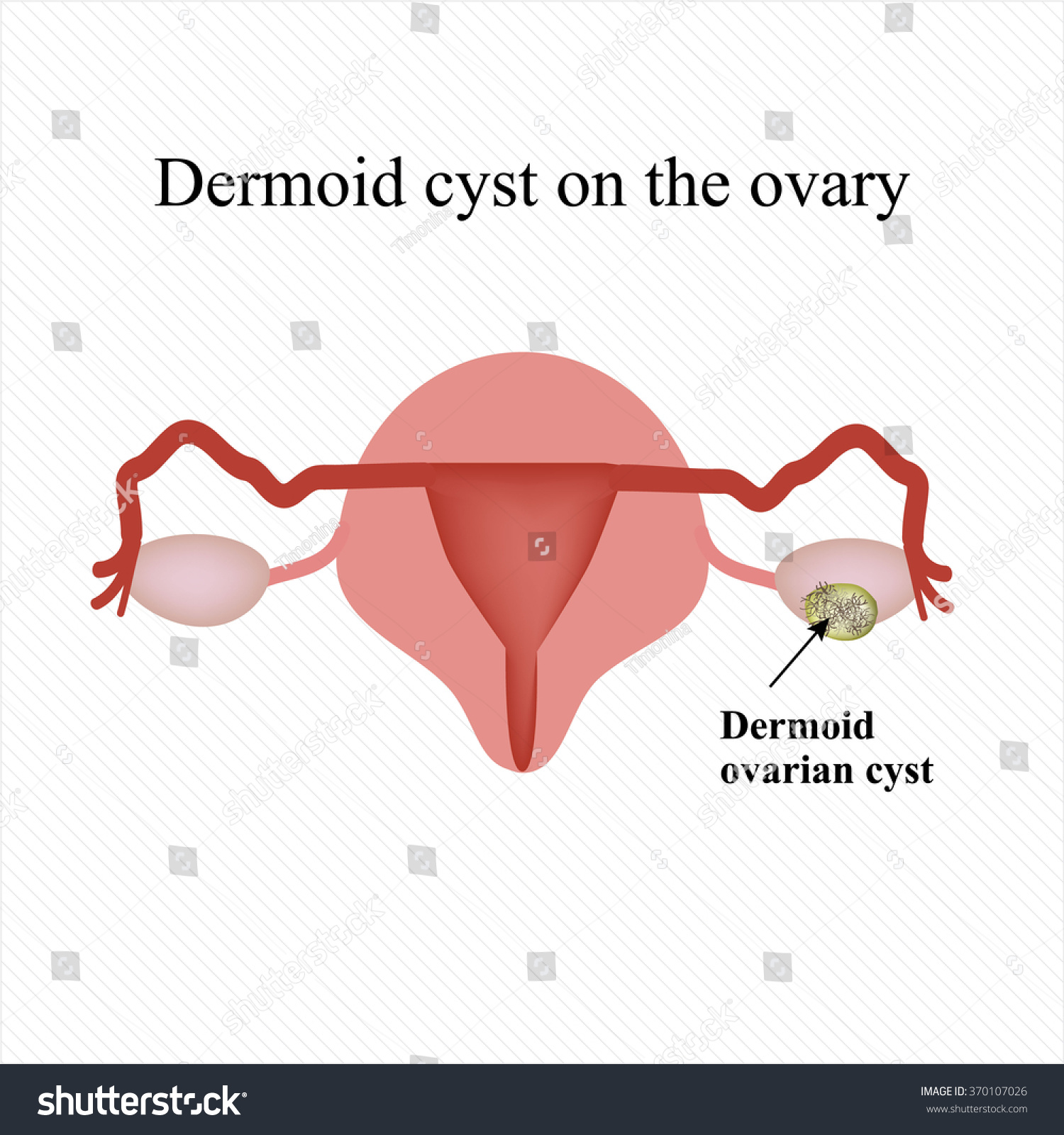 Ovarian Dermoid Cyst
