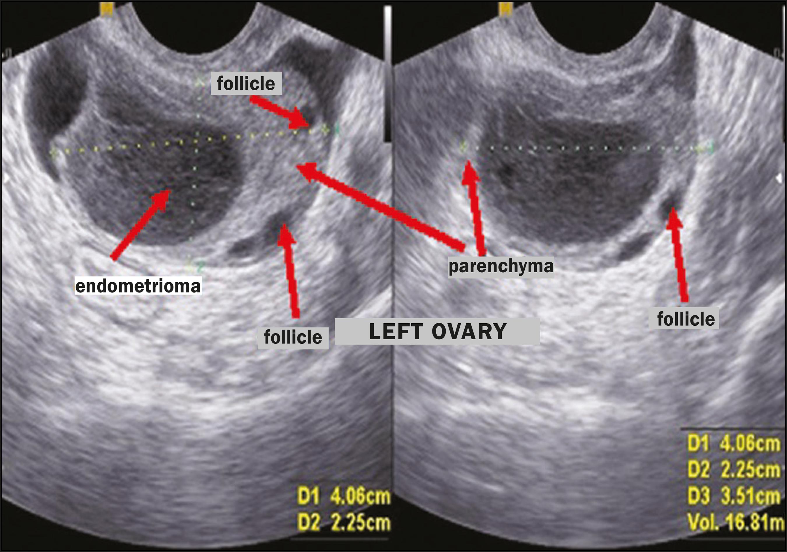 Ovary Normal Ultrasound