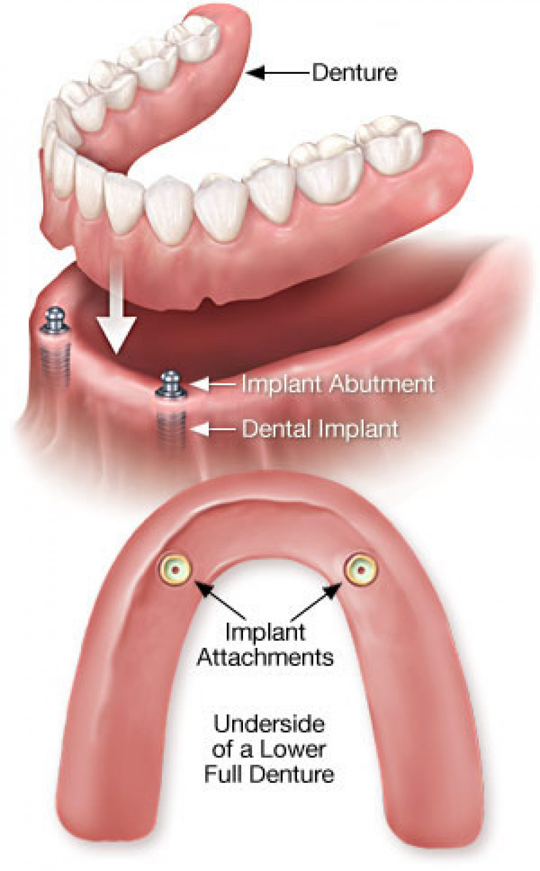Over Denture Implants