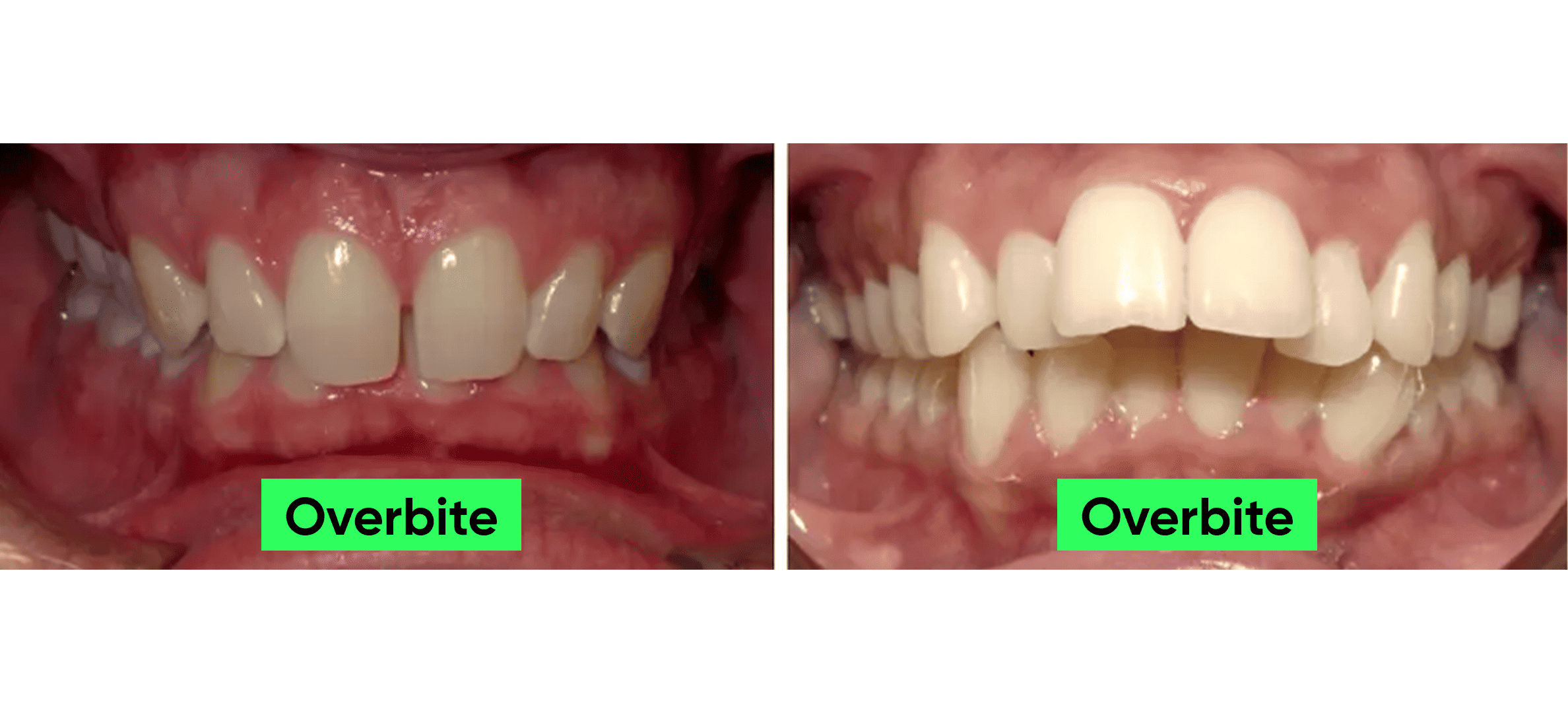 Overjet Vs Overbite