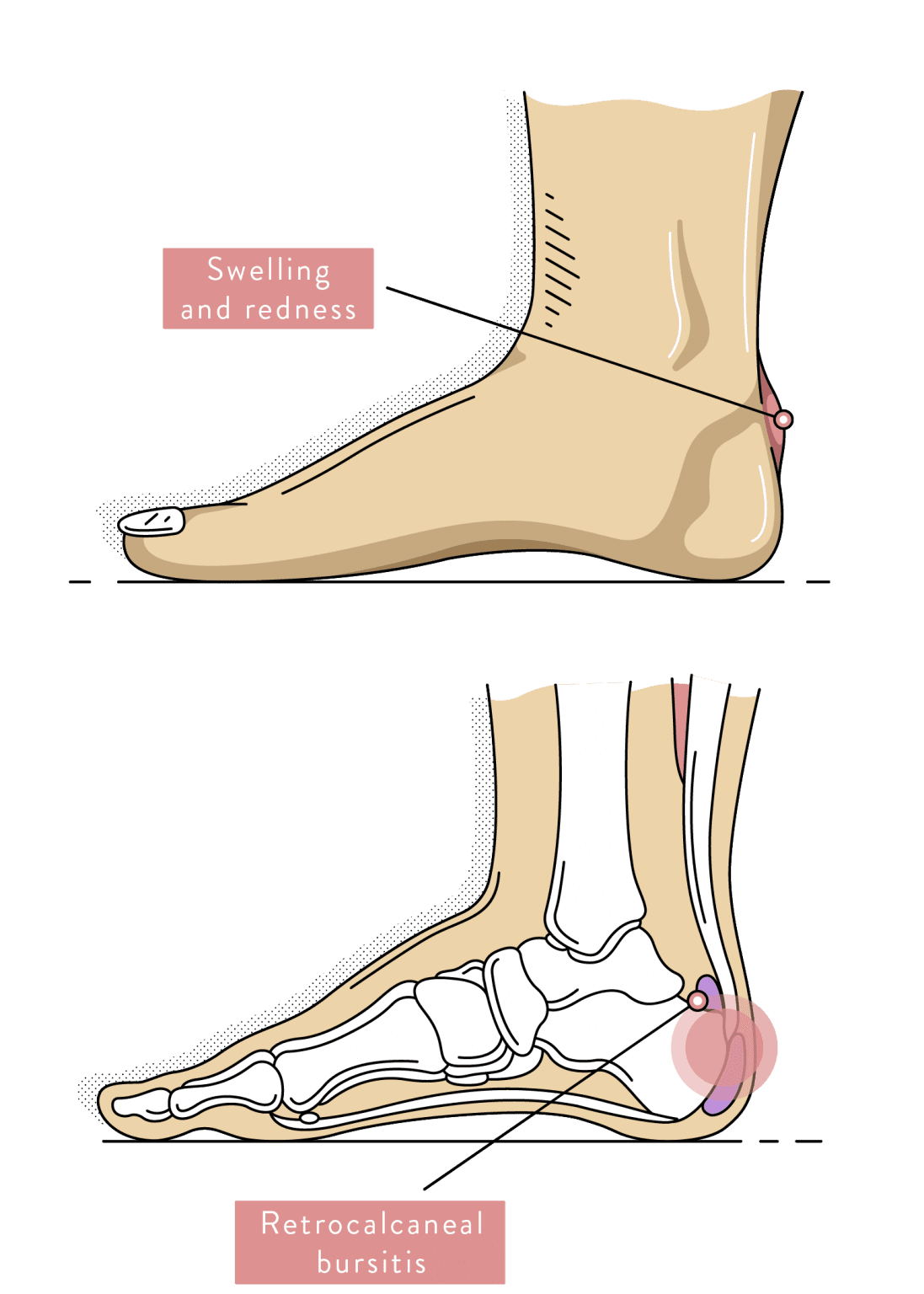 Pain At Back Of Heel
