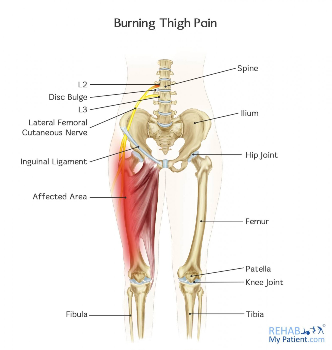 Pain At Upper Thigh