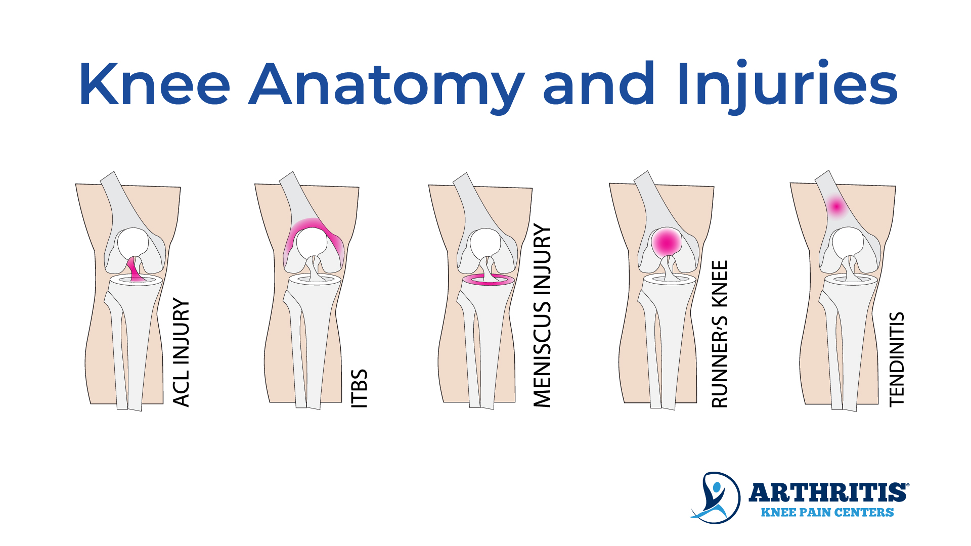 Pain Back Of Knee