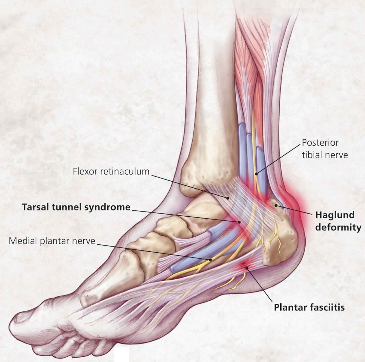 Pain Heel Of Foot