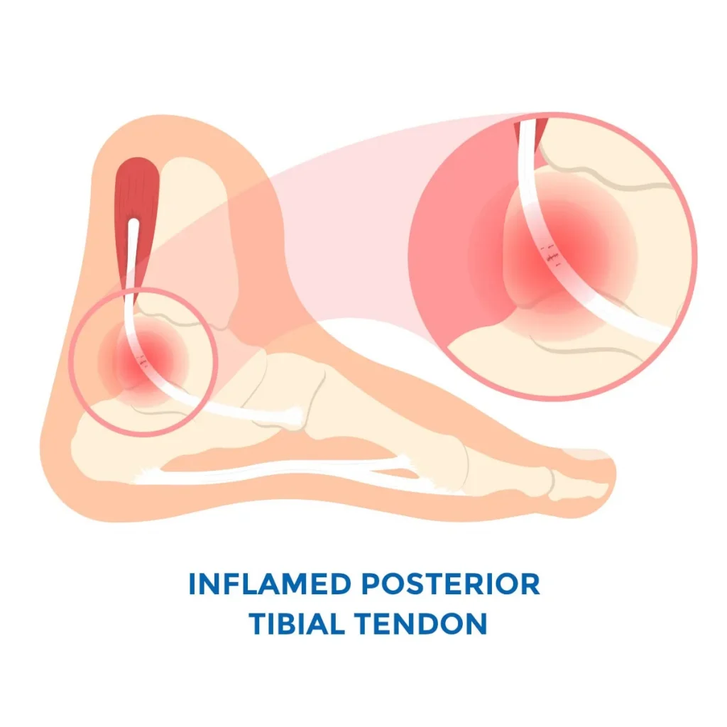 Pain On Inside Of Ankle