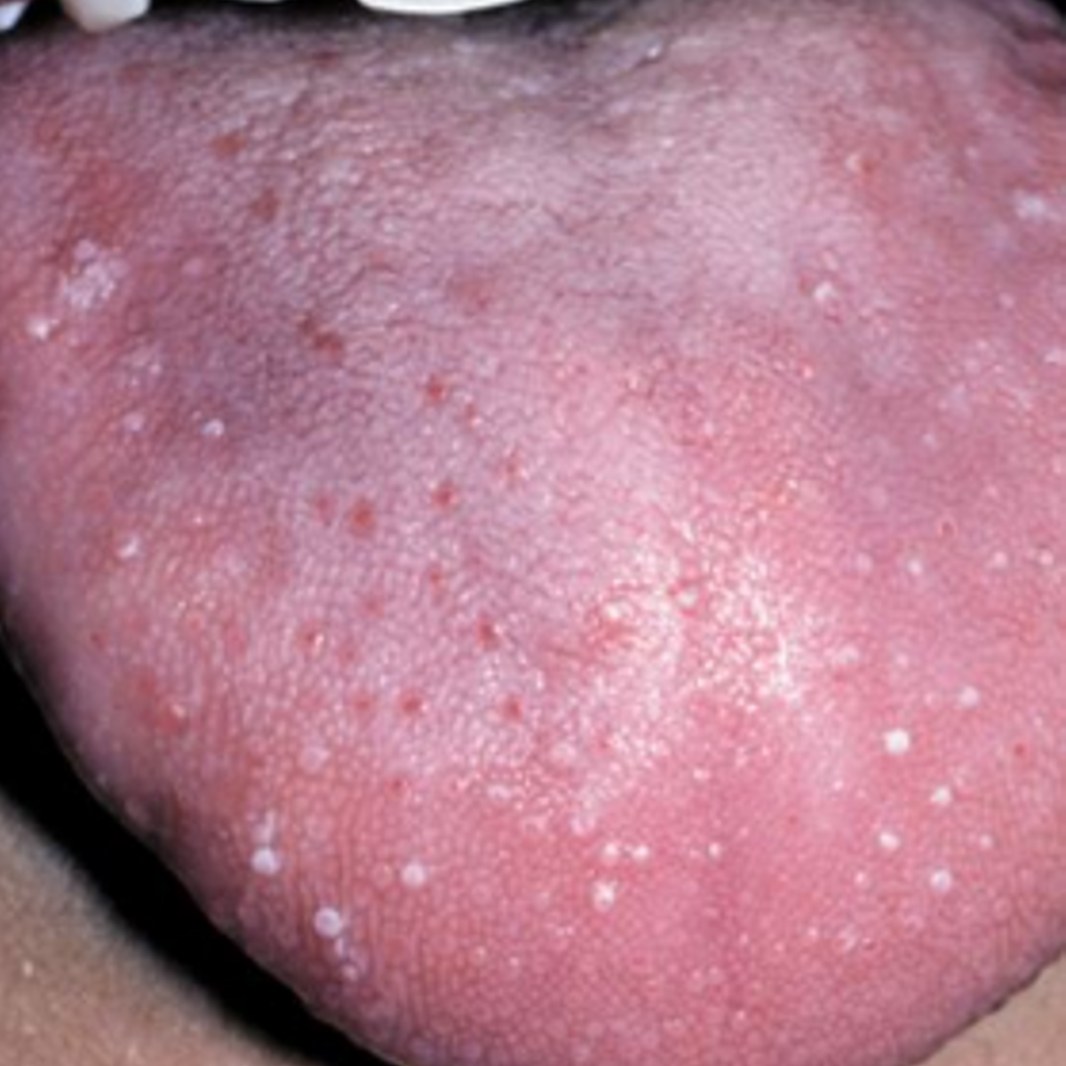 Painful White Bump On Tongue