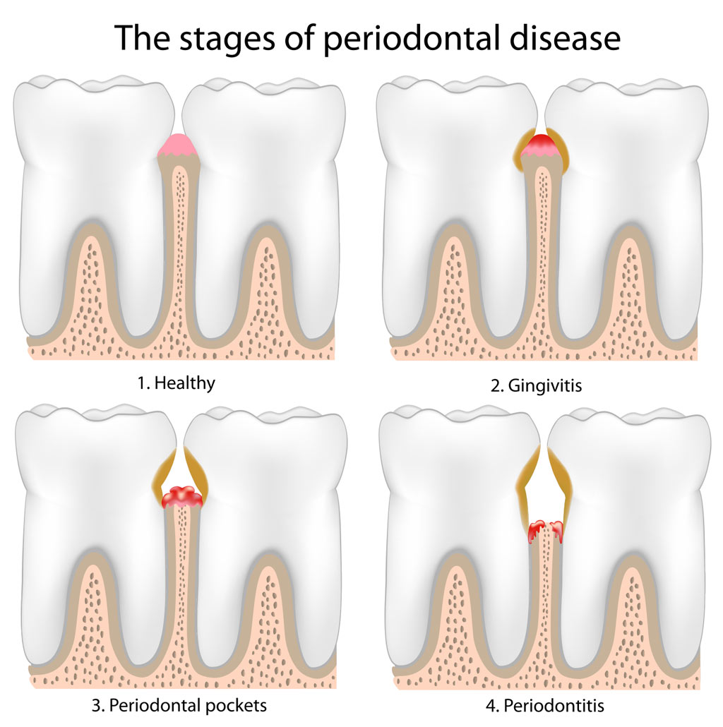 Pains In Gums
